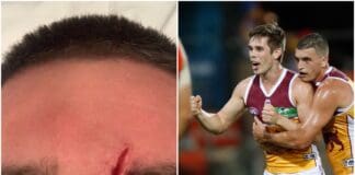 "Stamp out these cowards": Ex-Roo and Lion reveals gruesome injury after "coward hit"